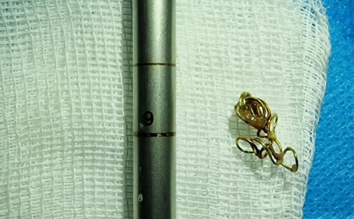 Проглотил пружину от ручки – врачи извлекли ее из дыхательных путей ребенка в Алматы