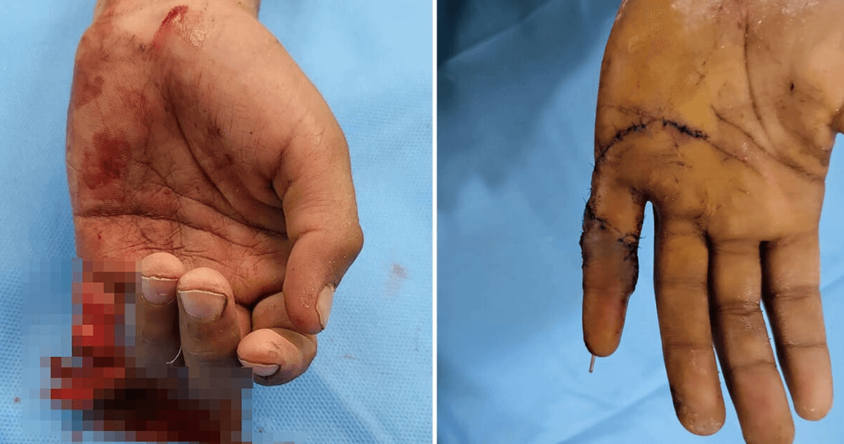Оторванный палец смогли пришить ребенку врачи в Алматы