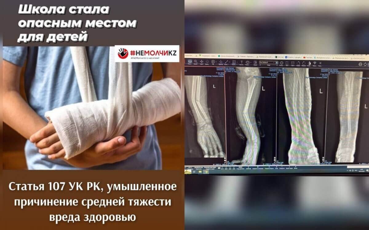 В Алматы школьник сломал однокласснику руку в двух местах