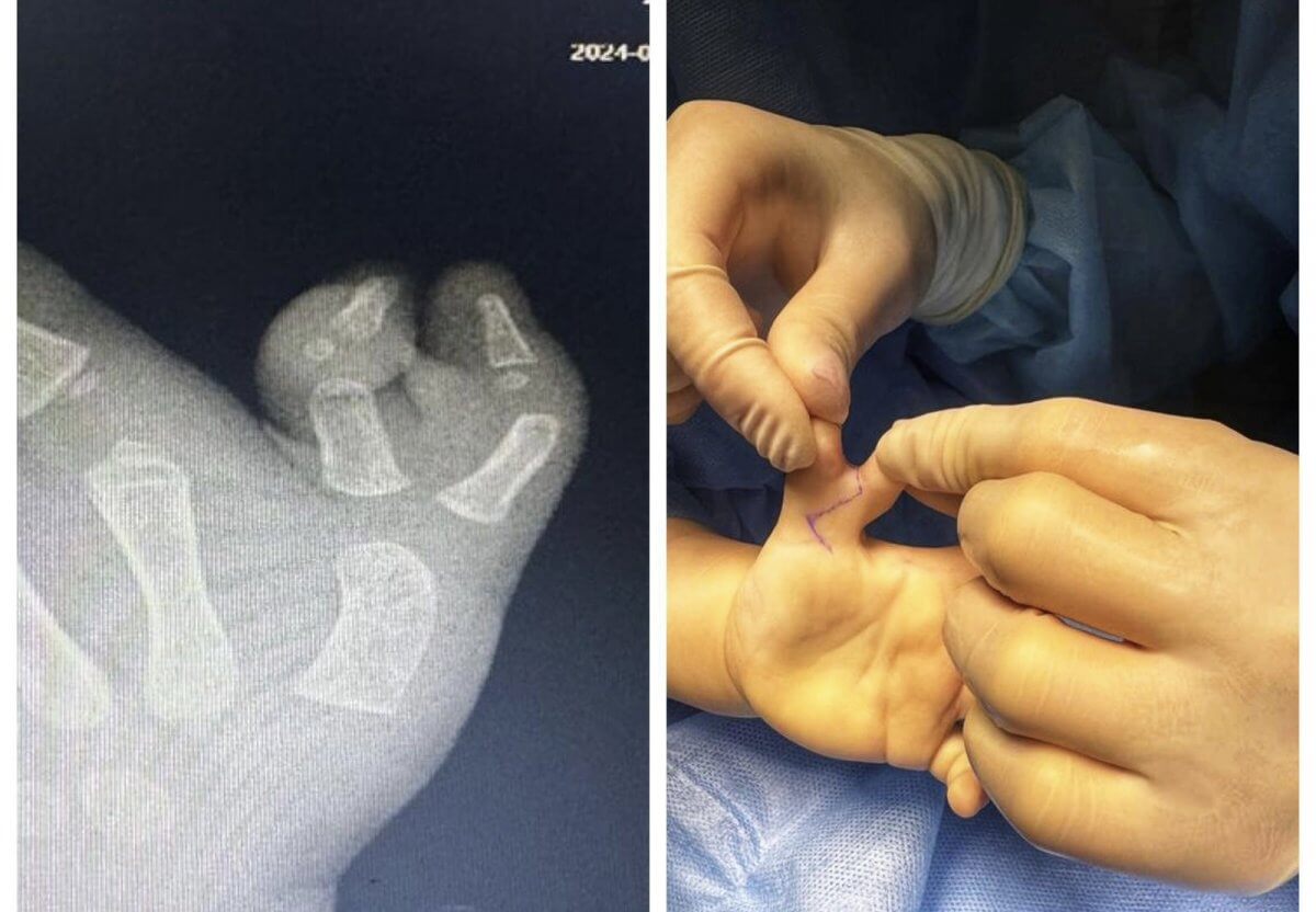 Сшили два пальца в один: В Алматы провели уникальную операцию на двухлетней девочке
