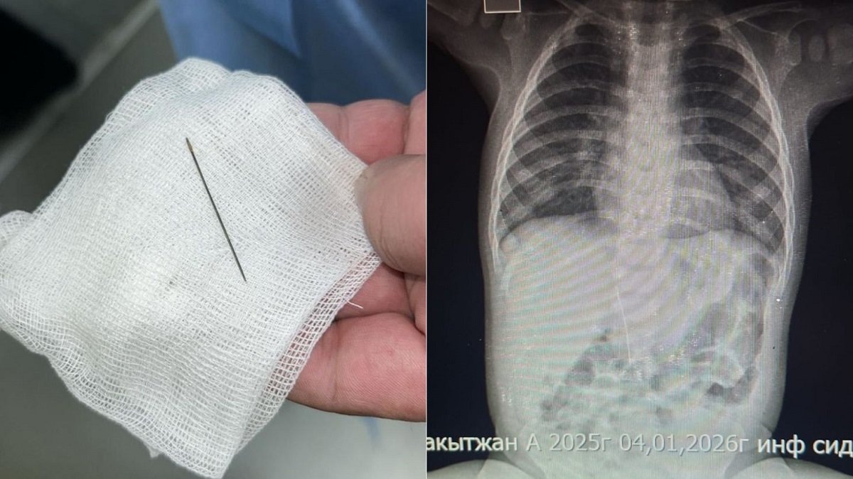 Иглу нашли у 8-месячного малыша во время обследования в Туркестане