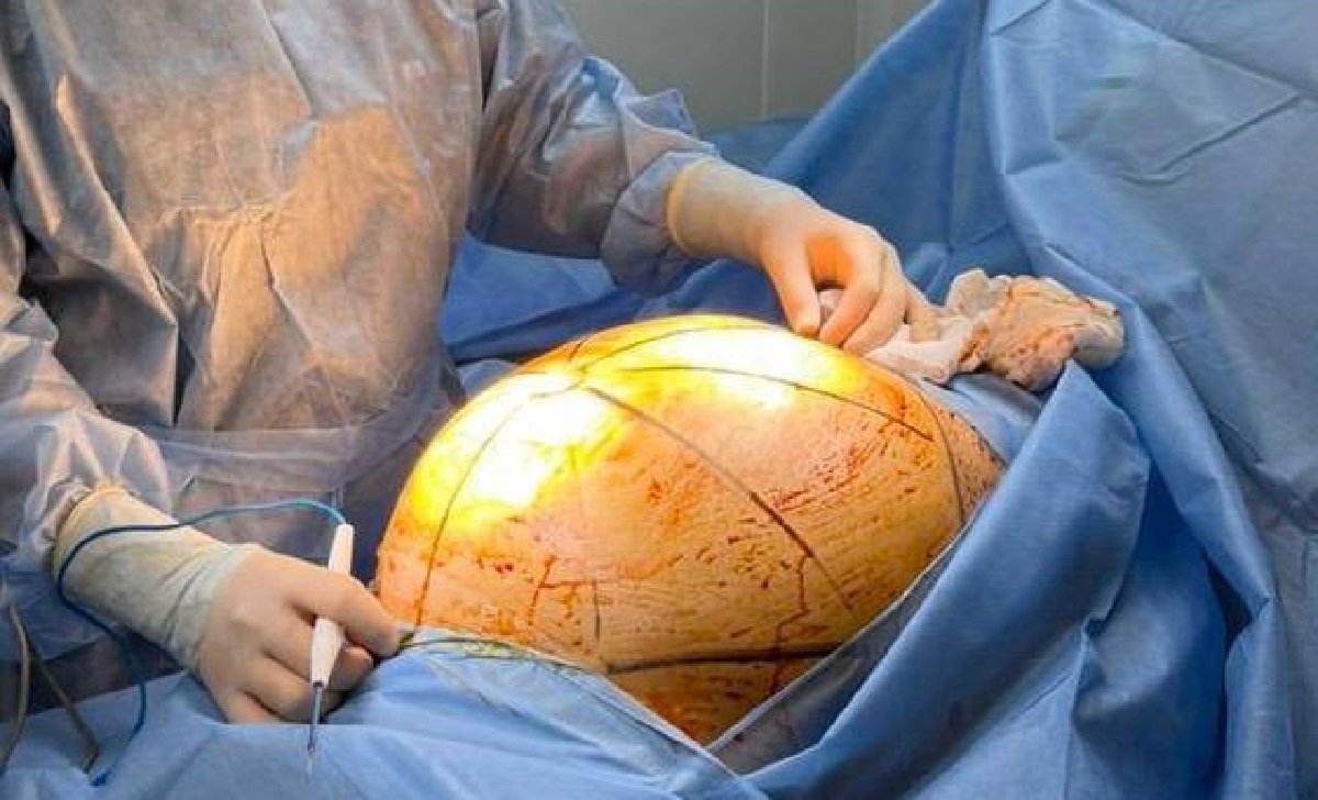 В Алматы пациентке удалили 25-килограммовую опухоль