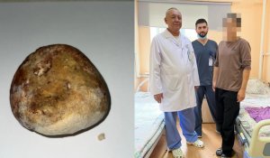 Врачи Алматы удалили огромный "камень" пациенту, восстановив мочеиспускание естественным путем