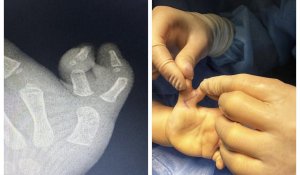 Сшили два пальца в один: В Алматы провели уникальную операцию на двухлетней девочке