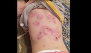 «У ребёнка 25 укусов»: ситуация в Шиелийском детсаду шокировала общественность