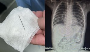 Иглу нашли у 8-месячного малыша во время обследования в Туркестане