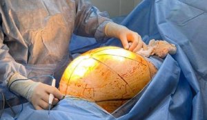 В Алматы пациентке удалили 25-килограммовую опухоль