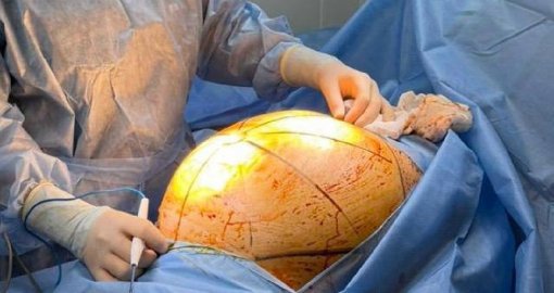 В Алматы пациентке удалили 25-килограммовую опухоль